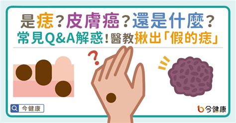 乳房長痣|是痣or皮膚癌？醫「1張圖秒對照」 長這2部位最危險